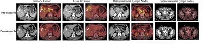 Case report: A de novo ERBB3 mutation develops in a gallbladder cancer patient carrying BRCA1 mutation after effective treatment with olaparib